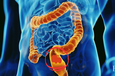 Cáncer de recto